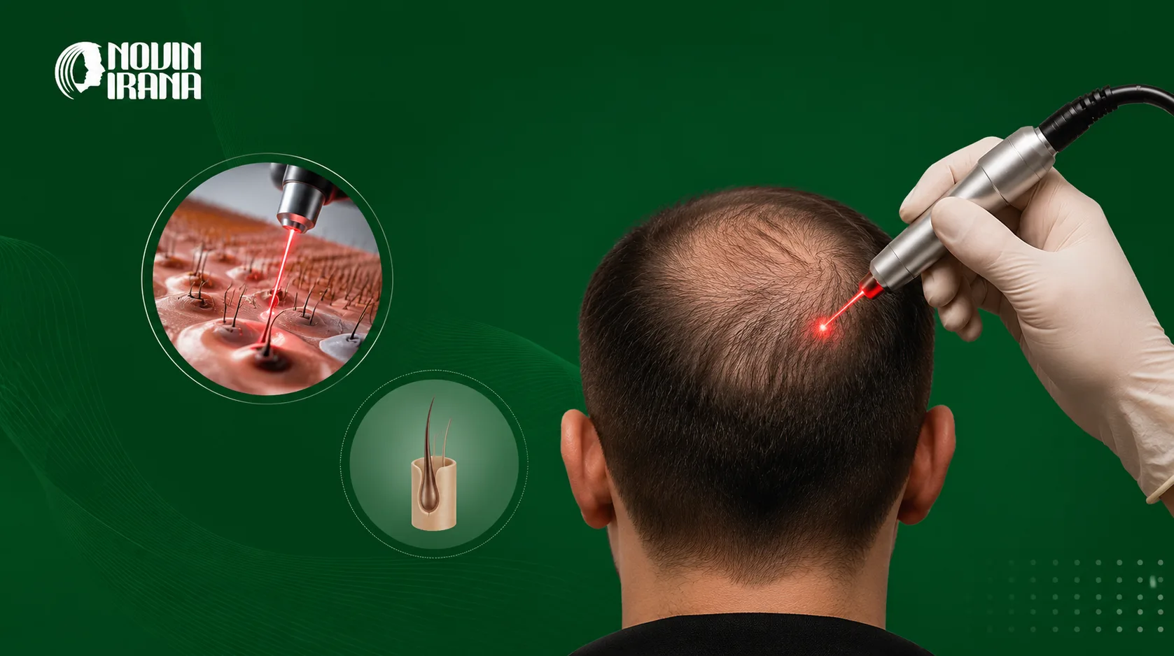 ما هي زراعة الشعر بالليزر وكيف تُجرى؟